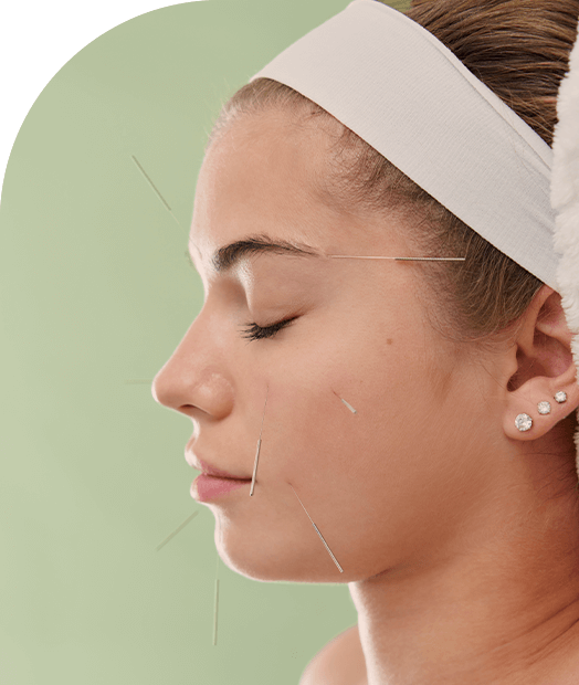 Image showcasing women taking acupunctute treatment